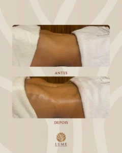 Antes-e-depois-nucleo-lume-2