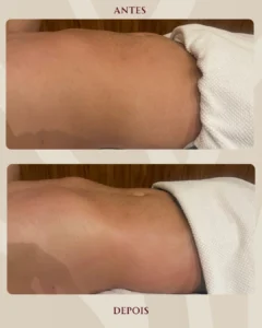 antes-e-depois-nucleo-lume-6